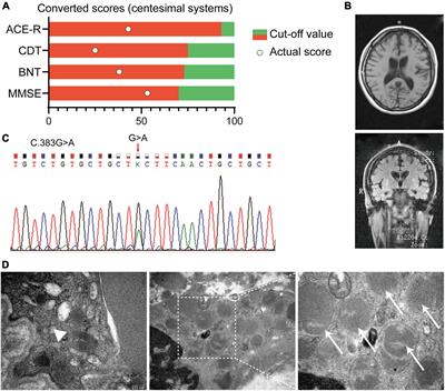 Adult-Onset Neuronal Ceroid Lipofuscinosis With a Novel DNAJC5 Mutation Exhibits Aberrant Protein Palmitoylation